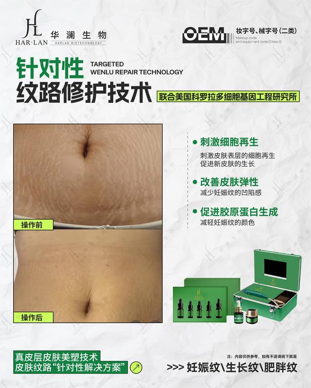 华澜生物7天美纹术妊娠纹烦恼不再难解决(图1)